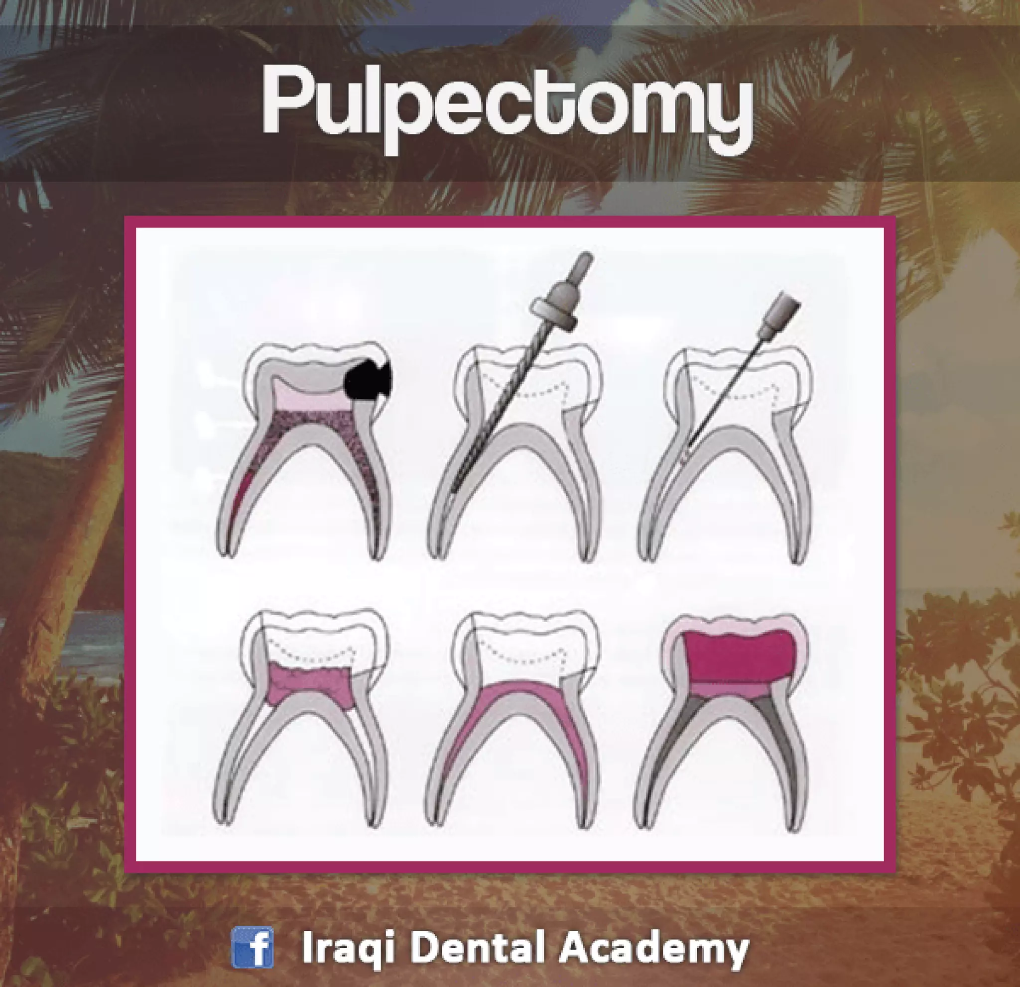 Pulpectomy Procedure Explained in brief