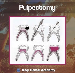 Pulpectomy Procedure Explained in brief