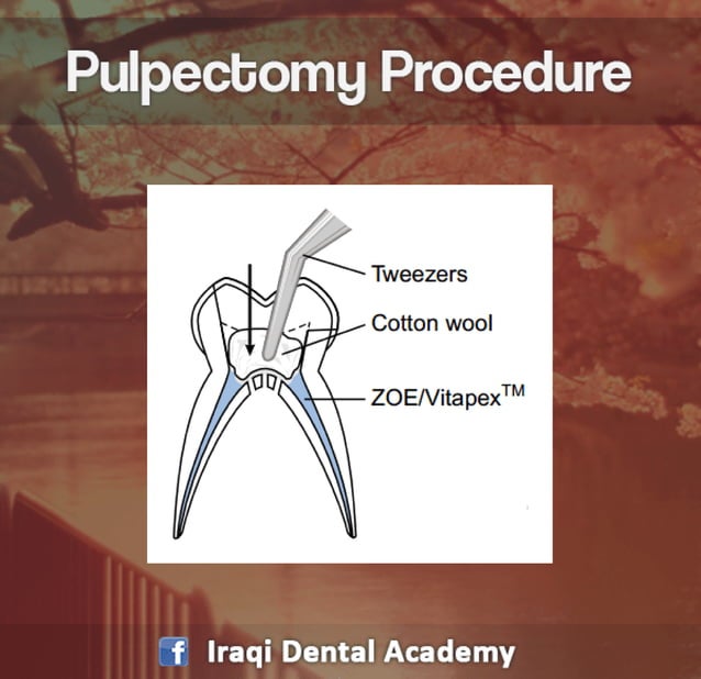 Pulpectomy Procedure Explained in brief