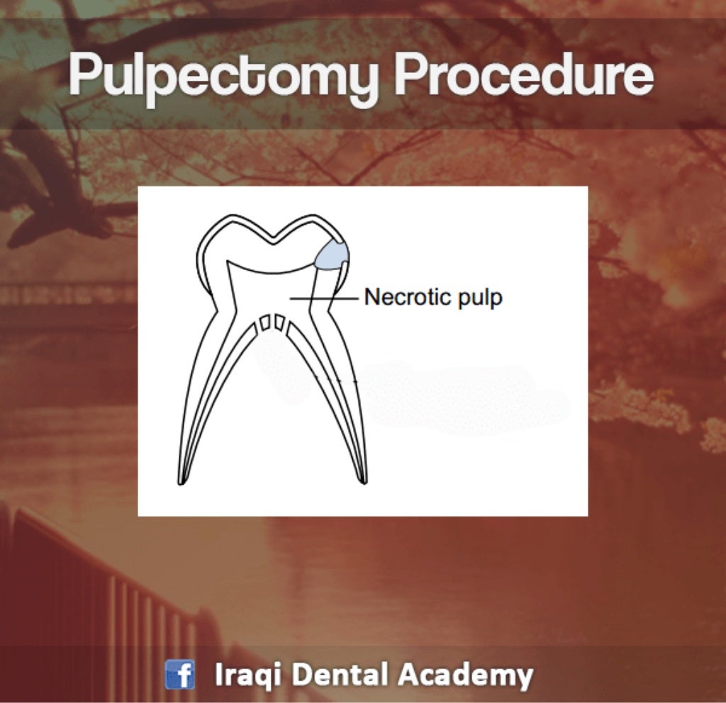Pulpectomy Procedure Explained in brief