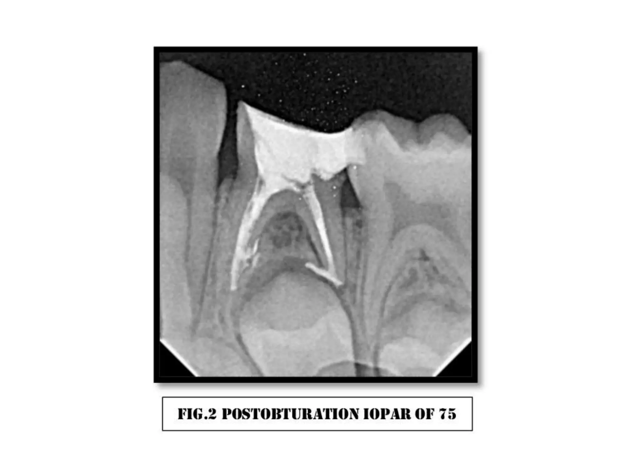 Pulpectomy with ss crown case 3