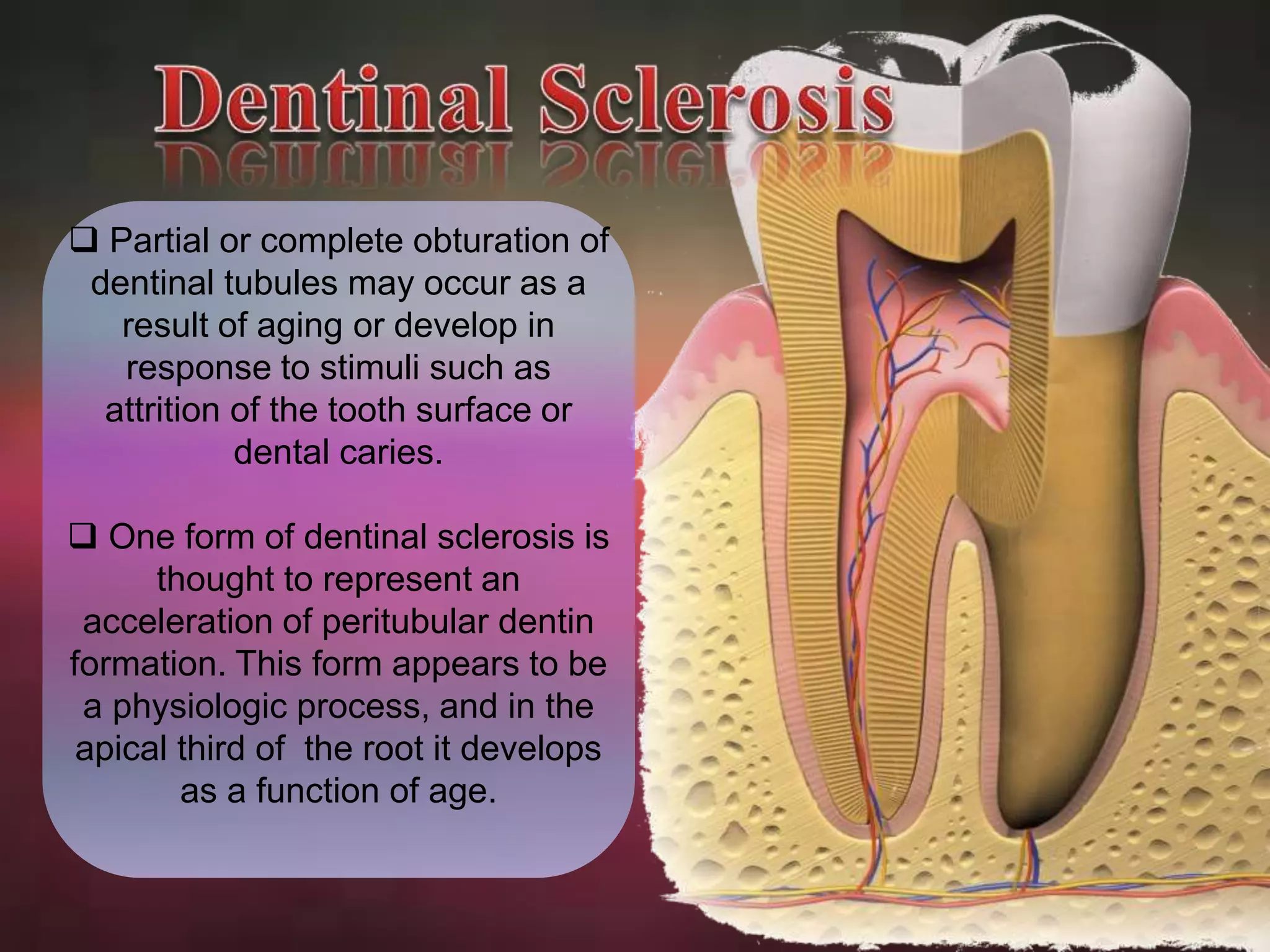  Partial or complete obturation of 
dentinal tubules may occur as a 
result of aging or develop in 
response to stimuli such as 
attrition of the tooth surface or 
dental caries. 
 One form of dentinal sclerosis is 
thought to represent an 
acceleration of peritubular dentin 
formation. This form appears to be 
a physiologic process, and in the 
apical third of the root it develops 
as a function of age. 
 