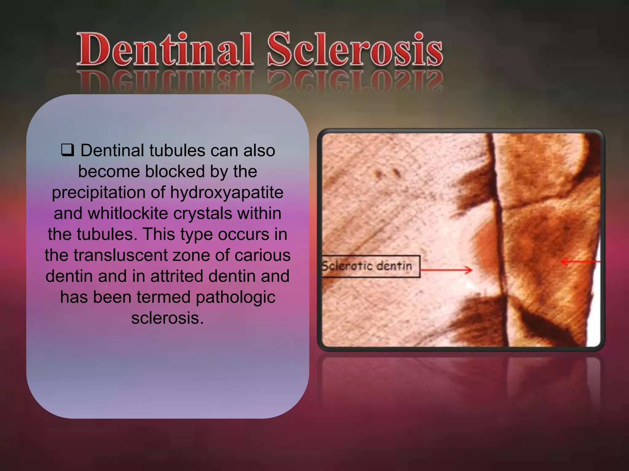  Dentinal tubules can also 
become blocked by the 
precipitation of hydroxyapatite 
and whitlockite crystals within 
the tubules. This type occurs in 
the transluscent zone of carious 
dentin and in attrited dentin and 
has been termed pathologic 
sclerosis. 
 