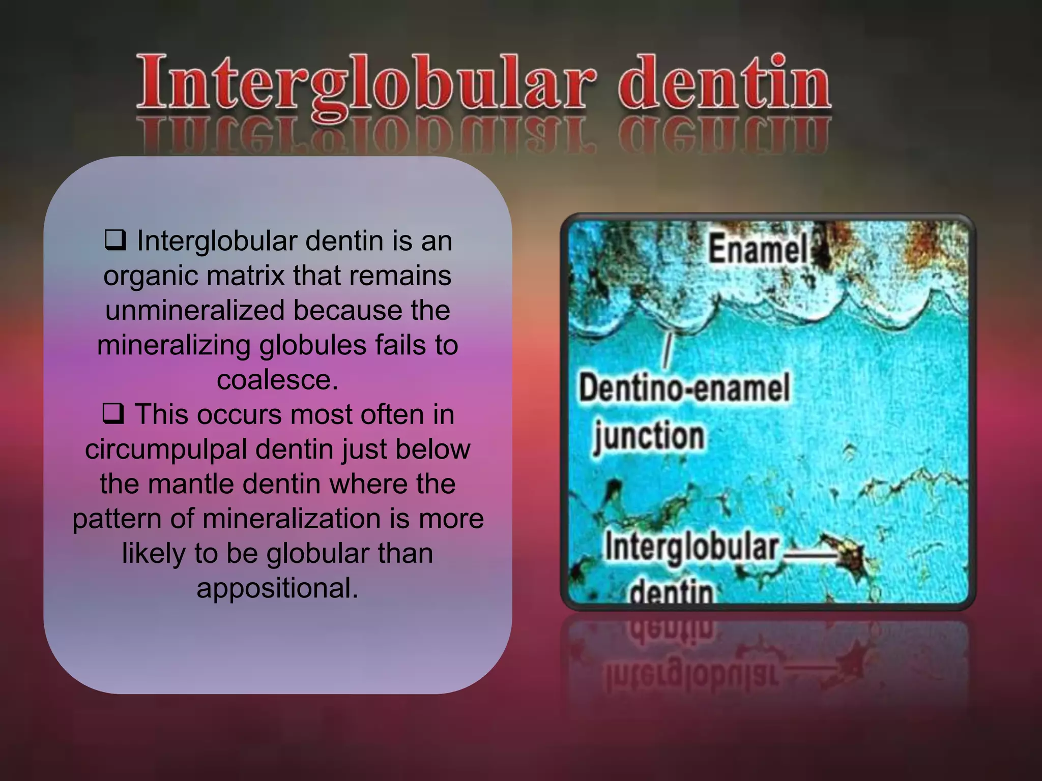  Interglobular dentin is an 
organic matrix that remains 
unmineralized because the 
mineralizing globules fails to 
coalesce. 
 This occurs most often in 
circumpulpal dentin just below 
the mantle dentin where the 
pattern of mineralization is more 
likely to be globular than 
appositional. 
 