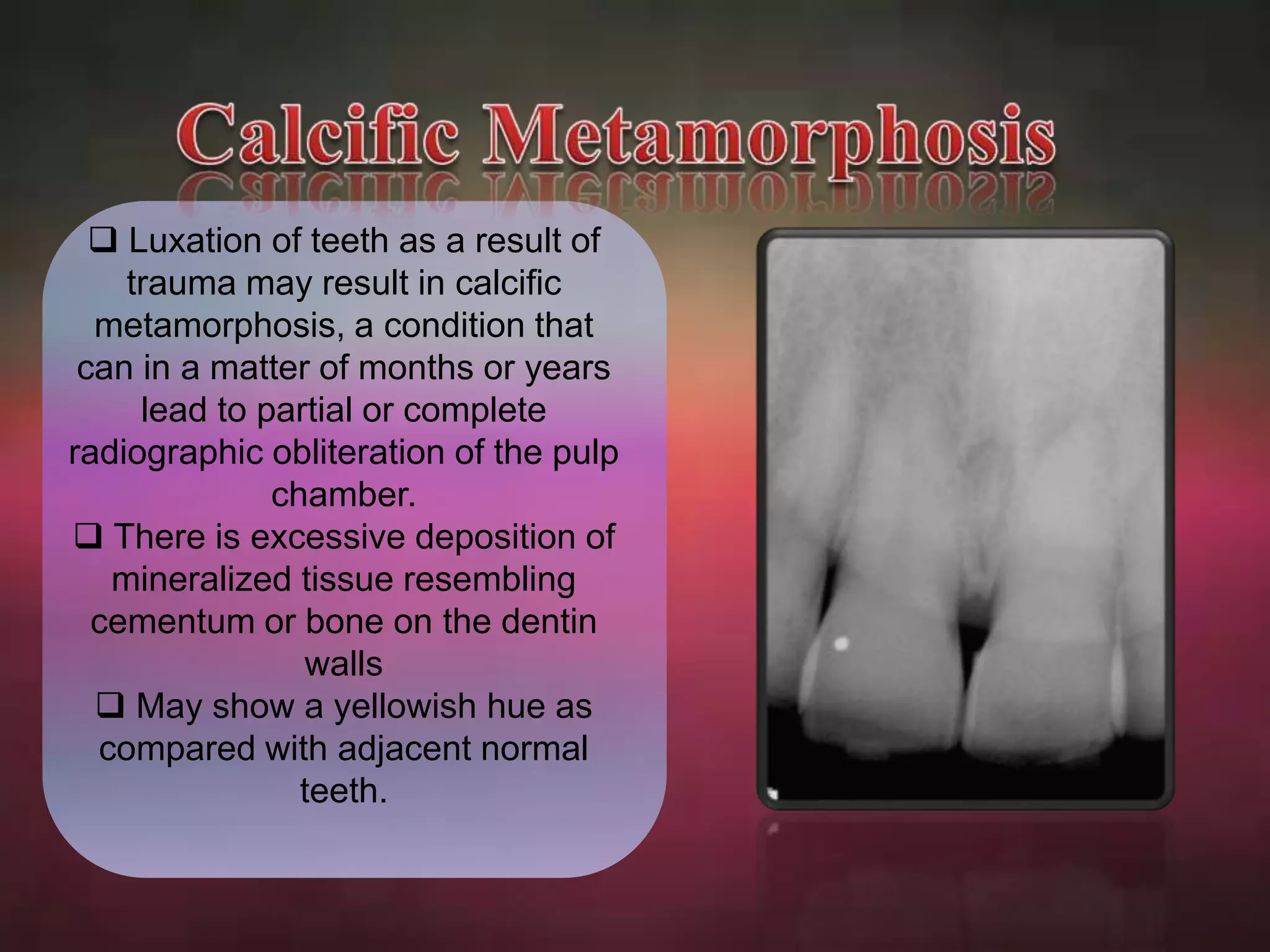  Luxation of teeth as a result of 
trauma may result in calcific 
metamorphosis, a condition that 
can in a matter of months or years 
lead to partial or complete 
radiographic obliteration of the pulp 
chamber. 
 There is excessive deposition of 
mineralized tissue resembling 
cementum or bone on the dentin 
walls 
 May show a yellowish hue as 
compared with adjacent normal 
teeth. 
 
