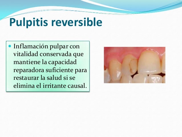 Pulpitis Aguda Pulpitis Aguda