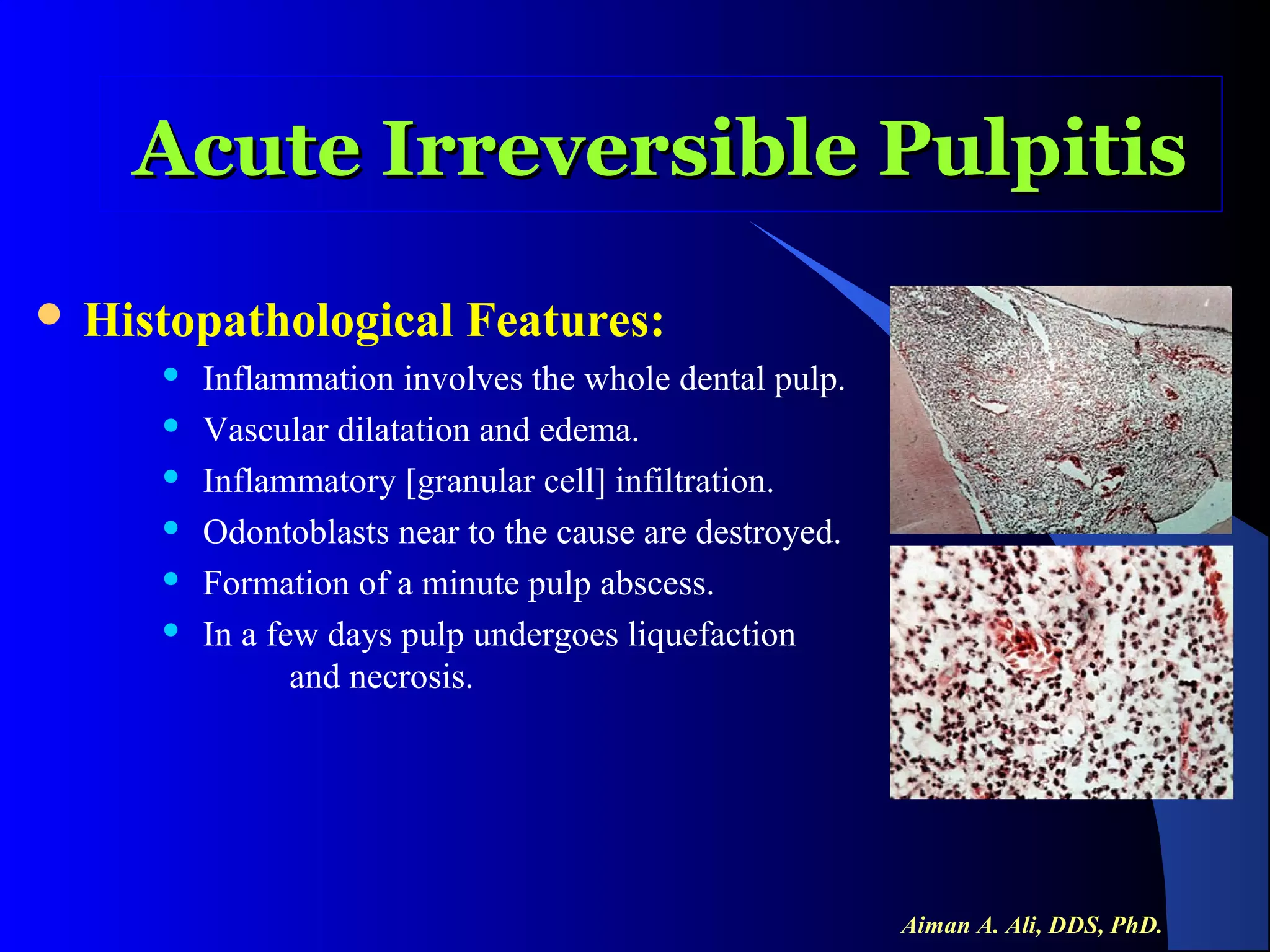 Acute Irreversible Pulpitis
 Histopathological







Features:

Inflammation involves the whole dental pulp.
Vascular dilatation and edema.
Inflammatory [granular cell] infiltration.
Odontoblasts near to the cause are destroyed.
Formation of a minute pulp abscess.
In a few days pulp undergoes liquefaction
and necrosis.

Aiman A. Ali, DDS, PhD.

 