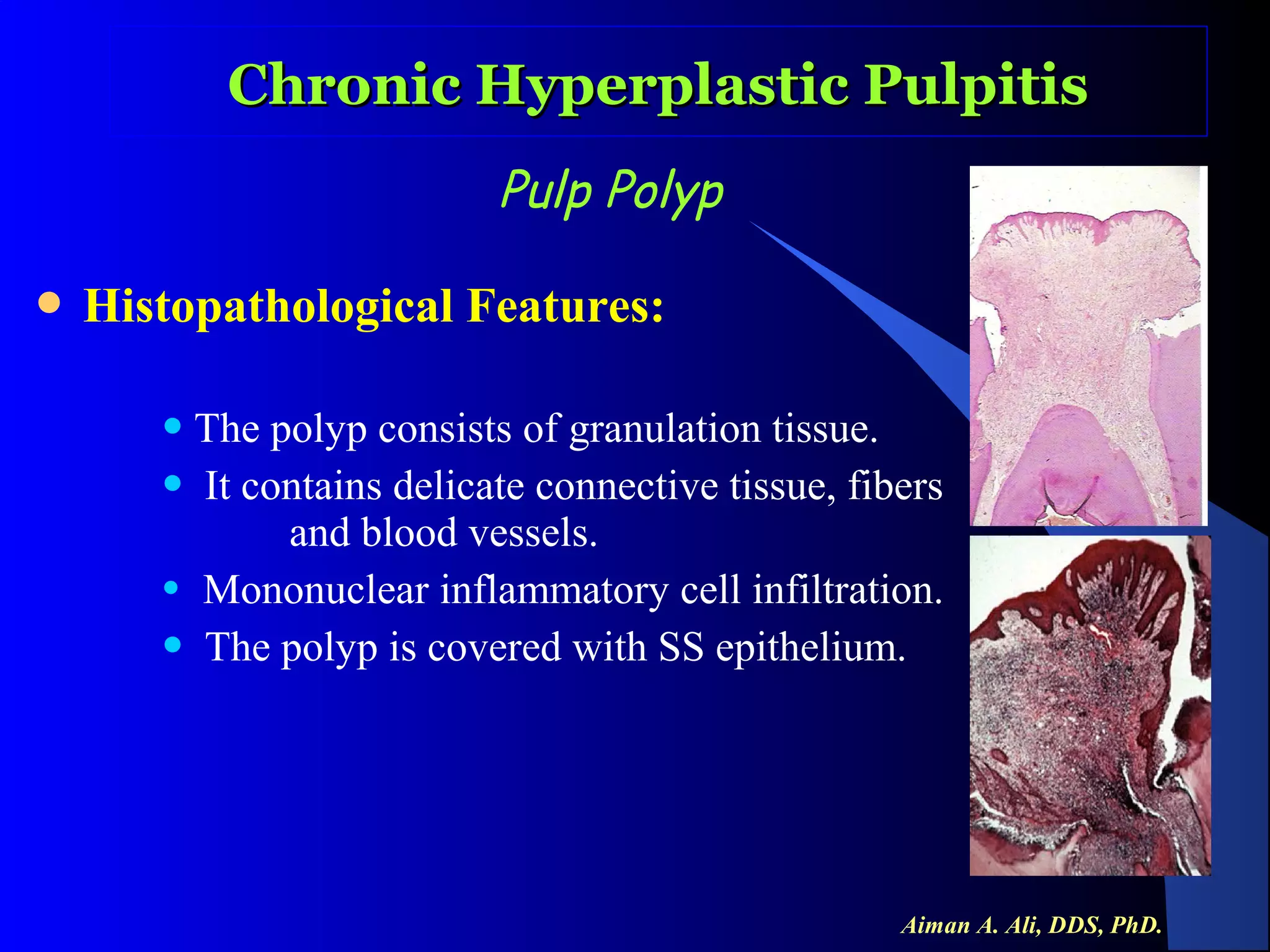 Chronic Hyperplastic Pulpitis
Pulp Polyp
 Histopathological

Features:

 The






polyp consists of granulation tissue.
It contains delicate connective tissue, fibers
and blood vessels.
Mononuclear inflammatory cell infiltration.
The polyp is covered with SS epithelium.

Aiman A. Ali, DDS, PhD.

 