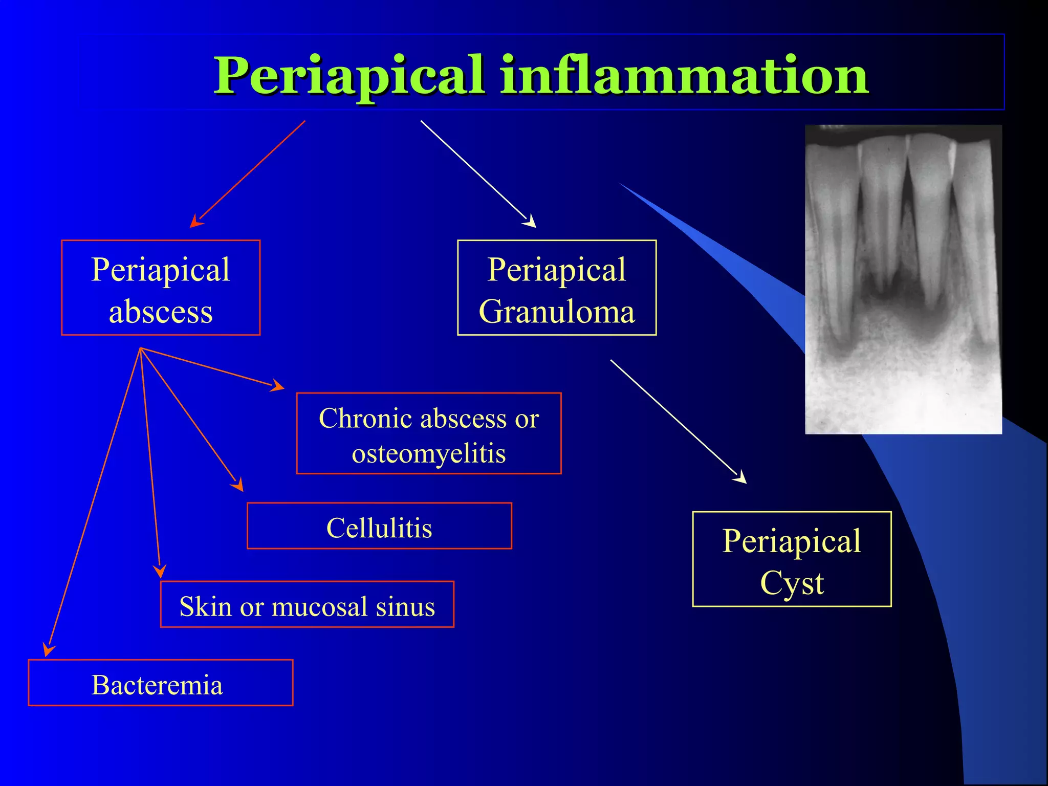 Periapical inflammation

Periapical
abscess

Periapical
Granuloma
Chronic abscess or
osteomyelitis
Cellulitis

Skin or mucosal sinus
Bacteremia

Periapical
Cyst

 