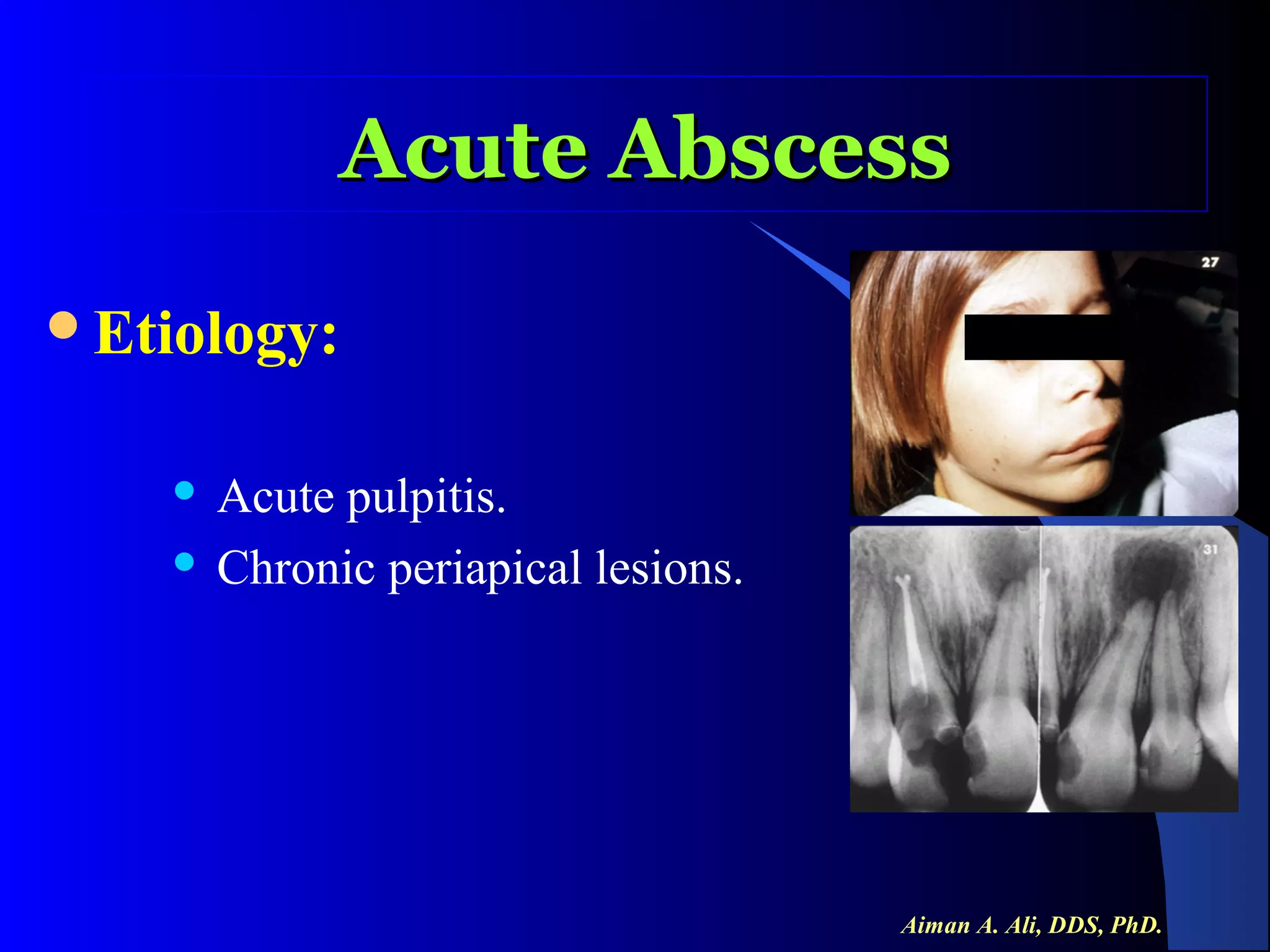 Acute Abscess
Etiology:

Acute pulpitis.
 Chronic periapical lesions.


Aiman A. Ali, DDS, PhD.

 