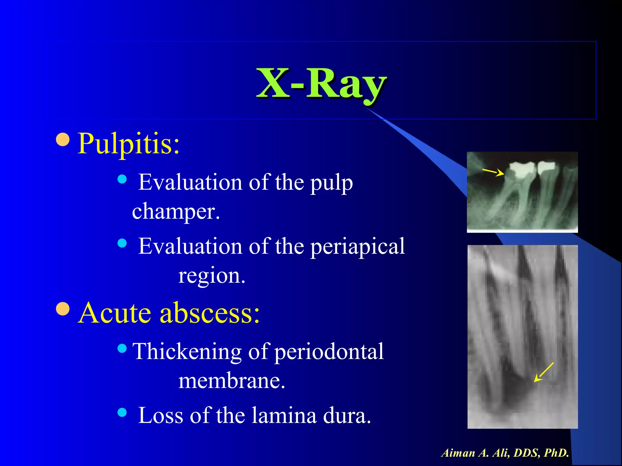 X-Ray
Pulpitis:

Evaluation of the pulp
champer.
 Evaluation of the periapical
region.


Acute

abscess:

Thickening

of periodontal
membrane.
 Loss of the lamina dura.
Aiman A. Ali, DDS, PhD.

 