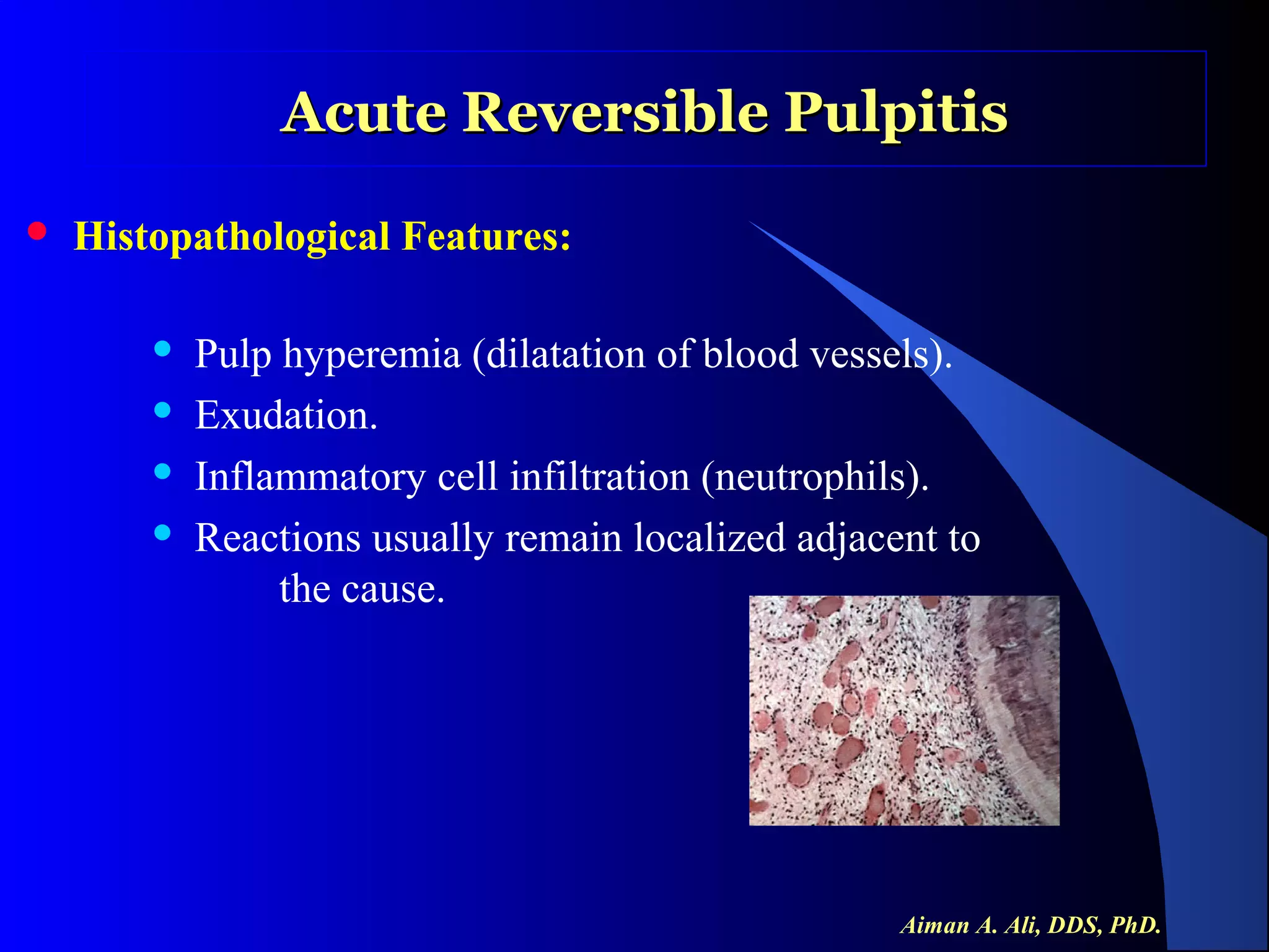 Acute Reversible Pulpitis


Histopathological Features:





Pulp hyperemia (dilatation of blood vessels).
Exudation.
Inflammatory cell infiltration (neutrophils).
Reactions usually remain localized adjacent to
the cause.

Aiman A. Ali, DDS, PhD.

 