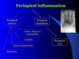 Periapical inflammation

Periapical
abscess

Periapical
Granuloma
Chronic abscess or
osteomyelitis
Cellulitis

Skin or mucosal sinus
Bacteremia

Periapical
Cyst

 