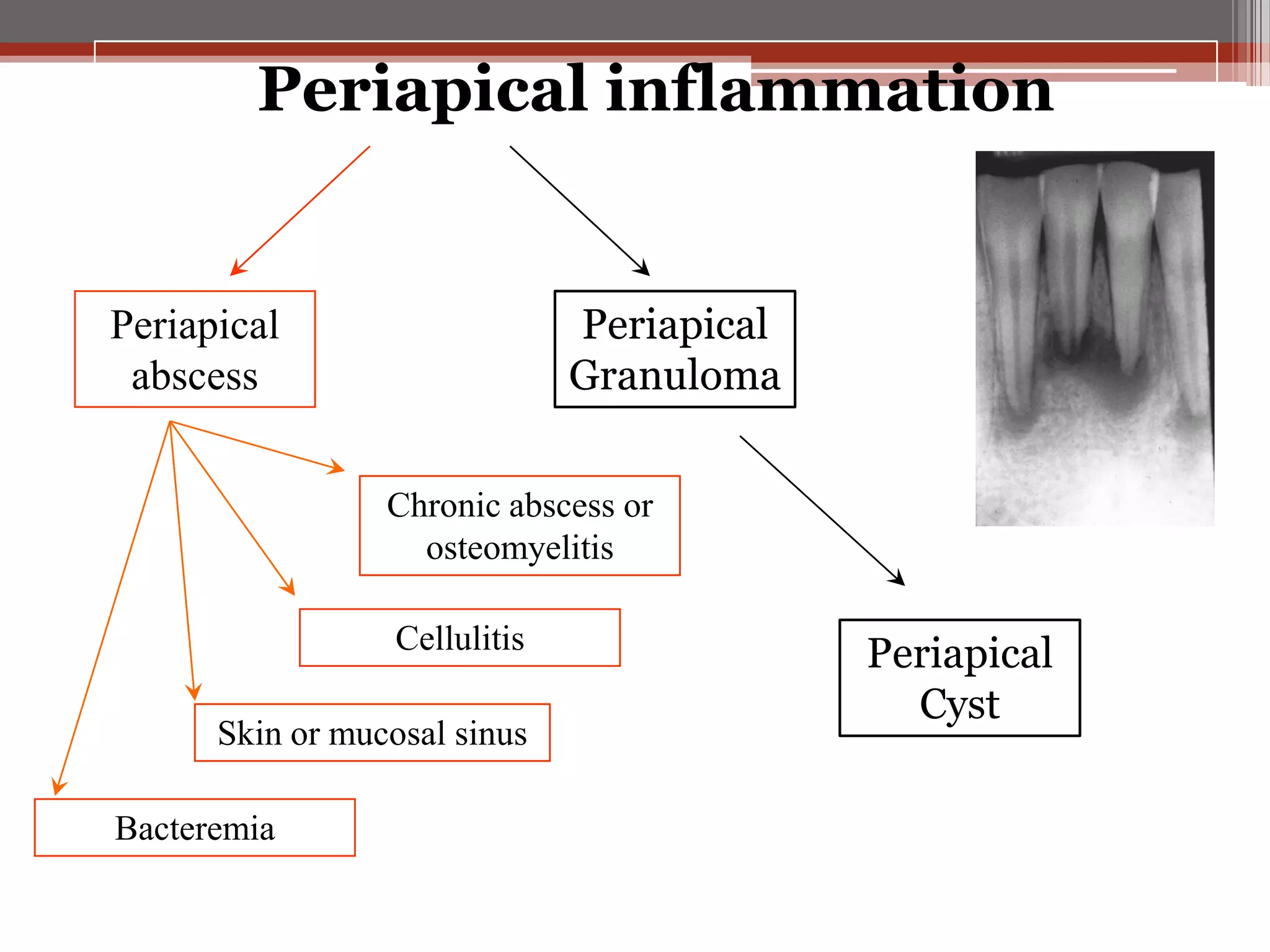 Periapical inflammation

Periapical
Granuloma

Periapical
abscess

Chronic abscess or
osteomyelitis
Cellulitis
Skin or mucosal sinus
Bacteremia

Periapical
Cyst

 