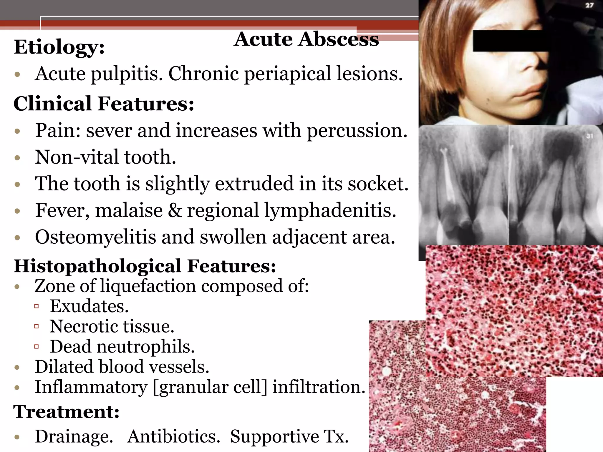 Acute Abscess
Etiology:
• Acute pulpitis. Chronic periapical lesions.
Clinical Features:
• Pain: sever and increases with percussion.
• Non-vital tooth.
• The tooth is slightly extruded in its socket.
• Fever, malaise & regional lymphadenitis.
• Osteomyelitis and swollen adjacent area.
Histopathological Features:
• Zone of liquefaction composed of:
▫ Exudates.
▫ Necrotic tissue.
▫ Dead neutrophils.
• Dilated blood vessels.
• Inflammatory [granular cell] infiltration.
Treatment:
• Drainage. Antibiotics. Supportive Tx.

 