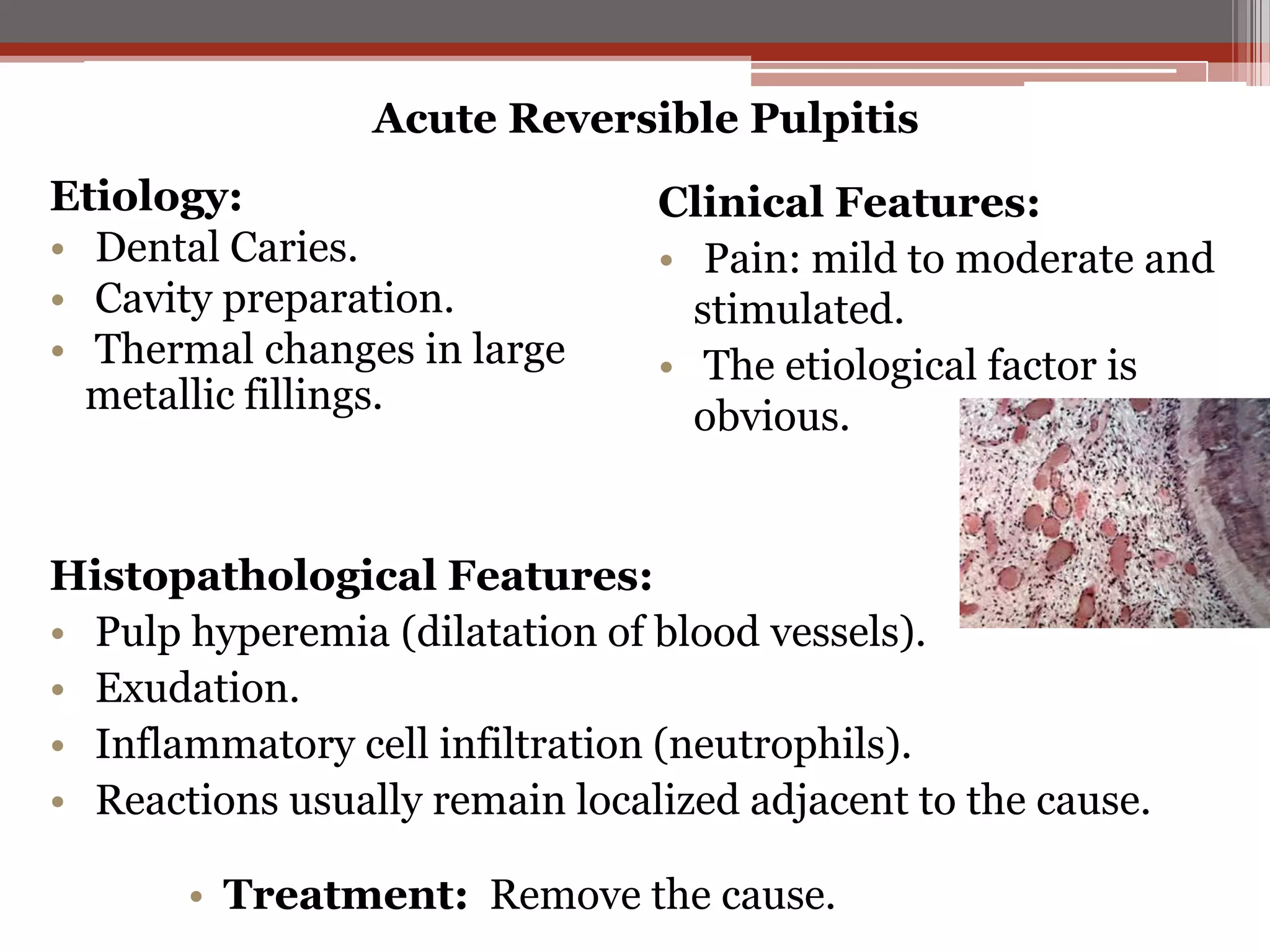 Acute Reversible Pulpitis
Etiology:
• Dental Caries.
• Cavity preparation.
• Thermal changes in large
metallic fillings.

Clinical Features:
• Pain: mild to moderate and
stimulated.
• The etiological factor is
obvious.

Histopathological Features:
• Pulp hyperemia (dilatation of blood vessels).
• Exudation.
• Inflammatory cell infiltration (neutrophils).
• Reactions usually remain localized adjacent to the cause.
• Treatment: Remove the cause.

 