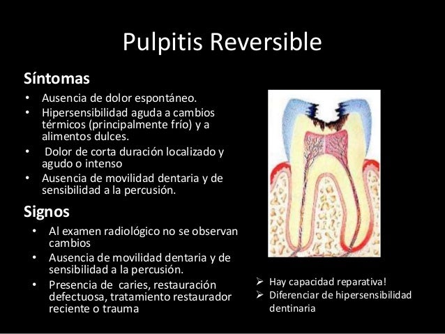 Pulpitis Aguda. Diagnostico Pulpitis Aguda. Diagnostico