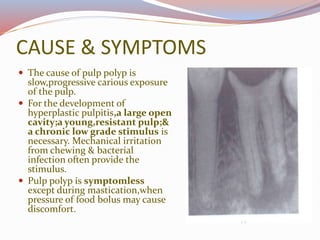 CAUSE & SYMPTOMS
 The cause of pulp polyp is
slow,progressive carious exposure
of the pulp.
 For the development of
hyperplastic pulpitis,a large open
cavity;a young,resistant pulp;&
a chronic low grade stimulus is
necessary. Mechanical irritation
from chewing & bacterial
infection often provide the
stimulus.
 Pulp polyp is symptomless
except during mastication,when
pressure of food bolus may cause
discomfort.
 