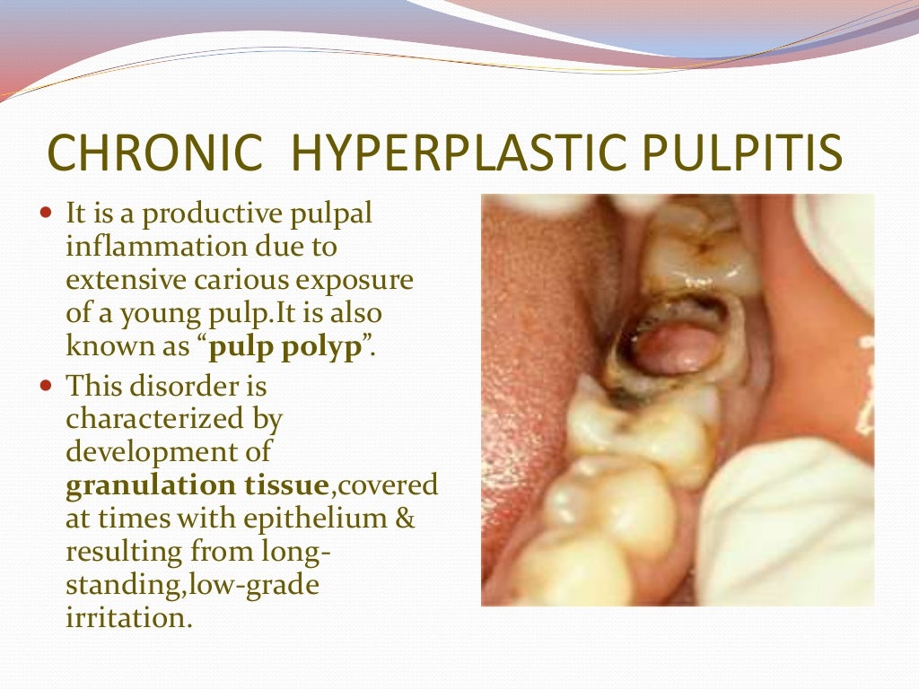 Pulpitis