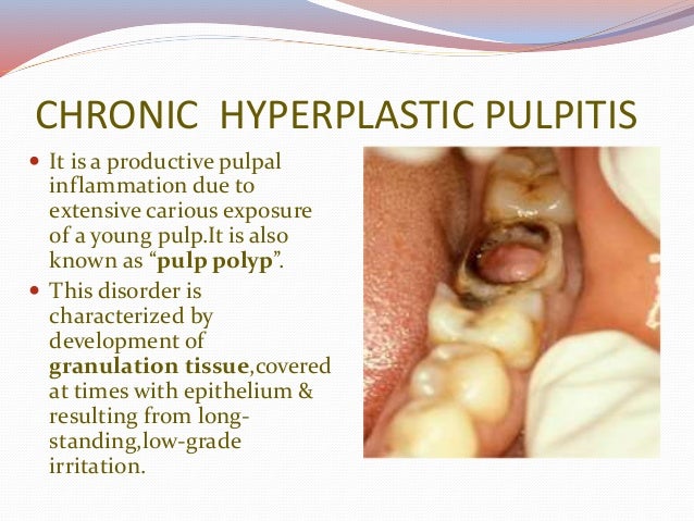 Pulpitis pressure decay diagram 
