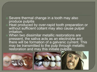 Pulpitis (exam oriented) | PPTX