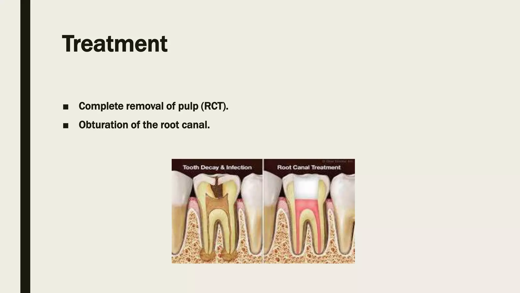 Pulpitis | PPTX
