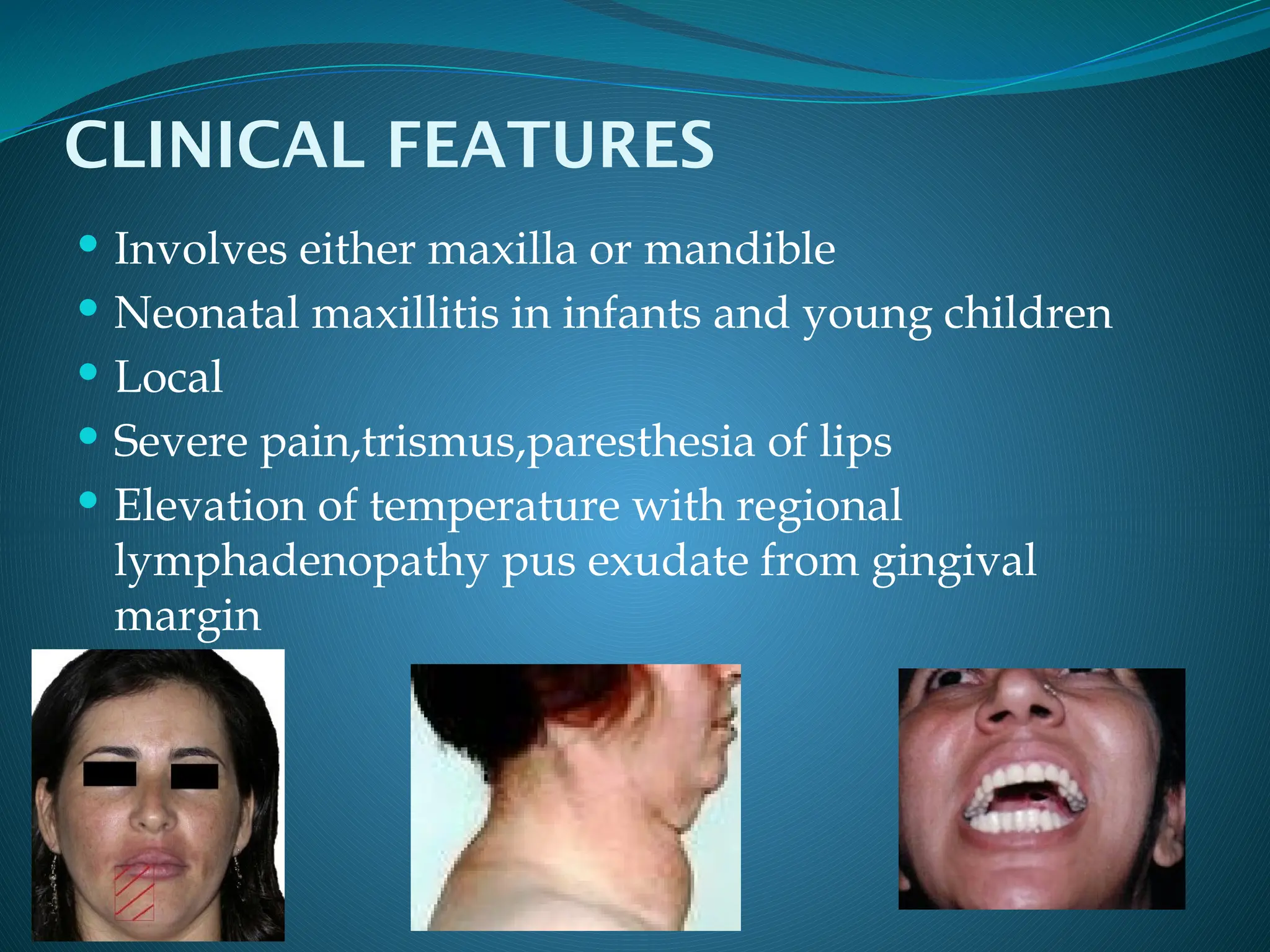 pulpitis and osteomyelitis types and classification.pptx