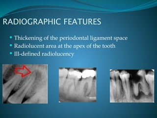 pulpitis and osteomyelitis types and classification.pptx