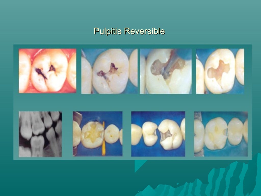 Pulpitis reversible e irreversible