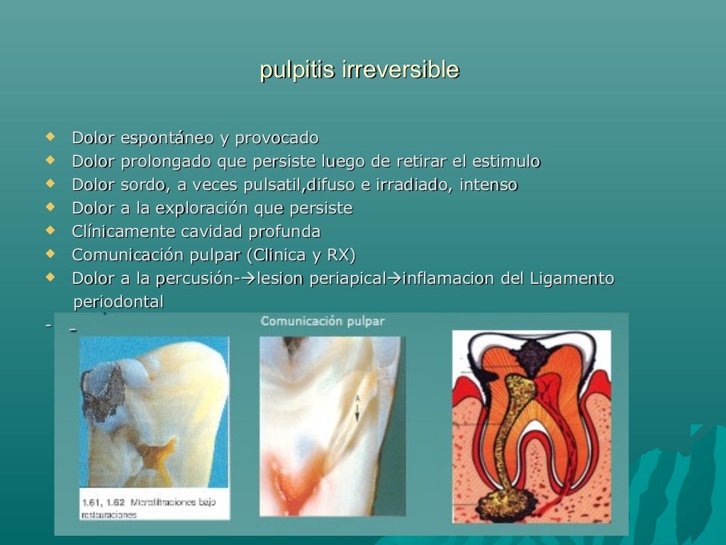 Pulpitis reversible e irreversible Pulpitis reversible e irreversible