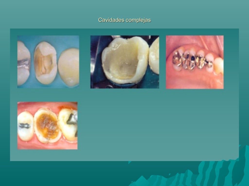 Pulpitis reversible e irreversible