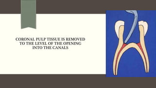 CORONAL PULP TISSUE IS REMOVED
TO THE LEVEL OF THE OPENING
INTO THE CANALS
 