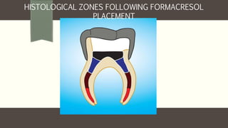HISTOLOGICAL ZONES FOLLOWING FORMACRESOL
PLACEMENT
 
