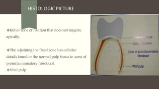 HISTOLOGICPICTURE
Initial zone of fixation that does not migrate
apically.
The adjoining the fixed zone has cellular
details found in the normal pulp tissue.ie: zone of
proinflammmatory fibroblast.
Vital pulp
 
