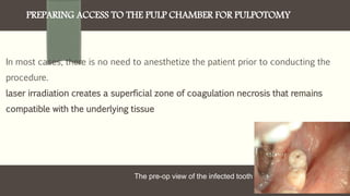 PREPARING ACCESS TO THE PULP CHAMBER FOR PULPOTOMY
In most cases, there is no need to anesthetize the patient prior to conducting the
procedure.
laser irradiation creates a superficial zone of coagulation necrosis that remains
compatible with the underlying tissue
The pre-op view of the infected tooth.
 
