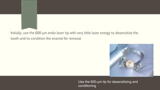 Initially, use the 600-μm endo laser tip with very little laser energy to desensitize the
tooth and to condition the enamel for removal
Use the 600-μm tip for desensitizing and
conditioning
 