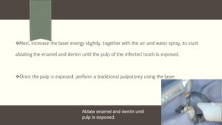 Next, increase the laser energy slightly, together with the air and water spray, to start
ablating the enamel and dentin until the pulp of the infected tooth is exposed.
Once the pulp is exposed, perform a traditional pulpotomy using the laser.
Ablate enamel and dentin until
pulp is exposed.
 