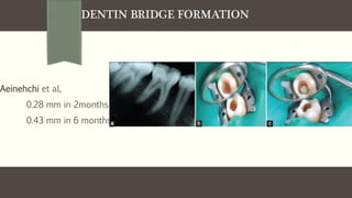 DENTIN BRIDGE FORMATION
Aeinehchi et al,
0.28 mm in 2months
0.43 mm in 6 months
 