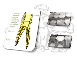 spontaneous pain, especially at night