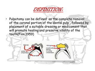 DEFINITION:Pulpotomy can be defined  as the complete removal  of the coronal portion of the dental pulp , followed by placement of a suitable dressing or medicament that will promote healing and preserve vitality of the tooth(Finn,1959)