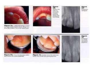 On excavaction of deep caries pulp exposure is encountered,ensure that the exposed site is free of debris.