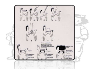 Enlarge the cavity with round bur