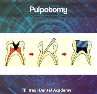 Pulpotomy Procedure for Pediatrics in Detail