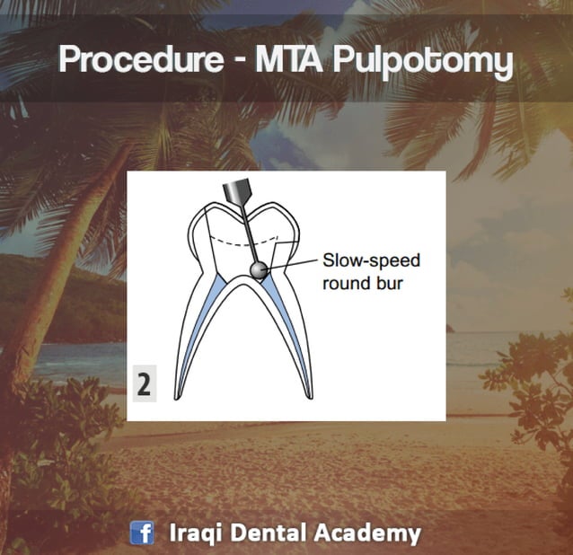 Pulpotomy Procedure for Pediatrics in Detail