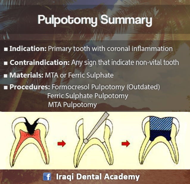 Pulpotomy Procedure for Pediatrics in Detail