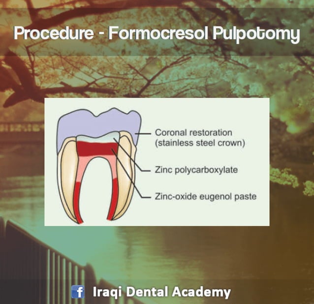 Pulpotomy Procedure for Pediatrics in Detail