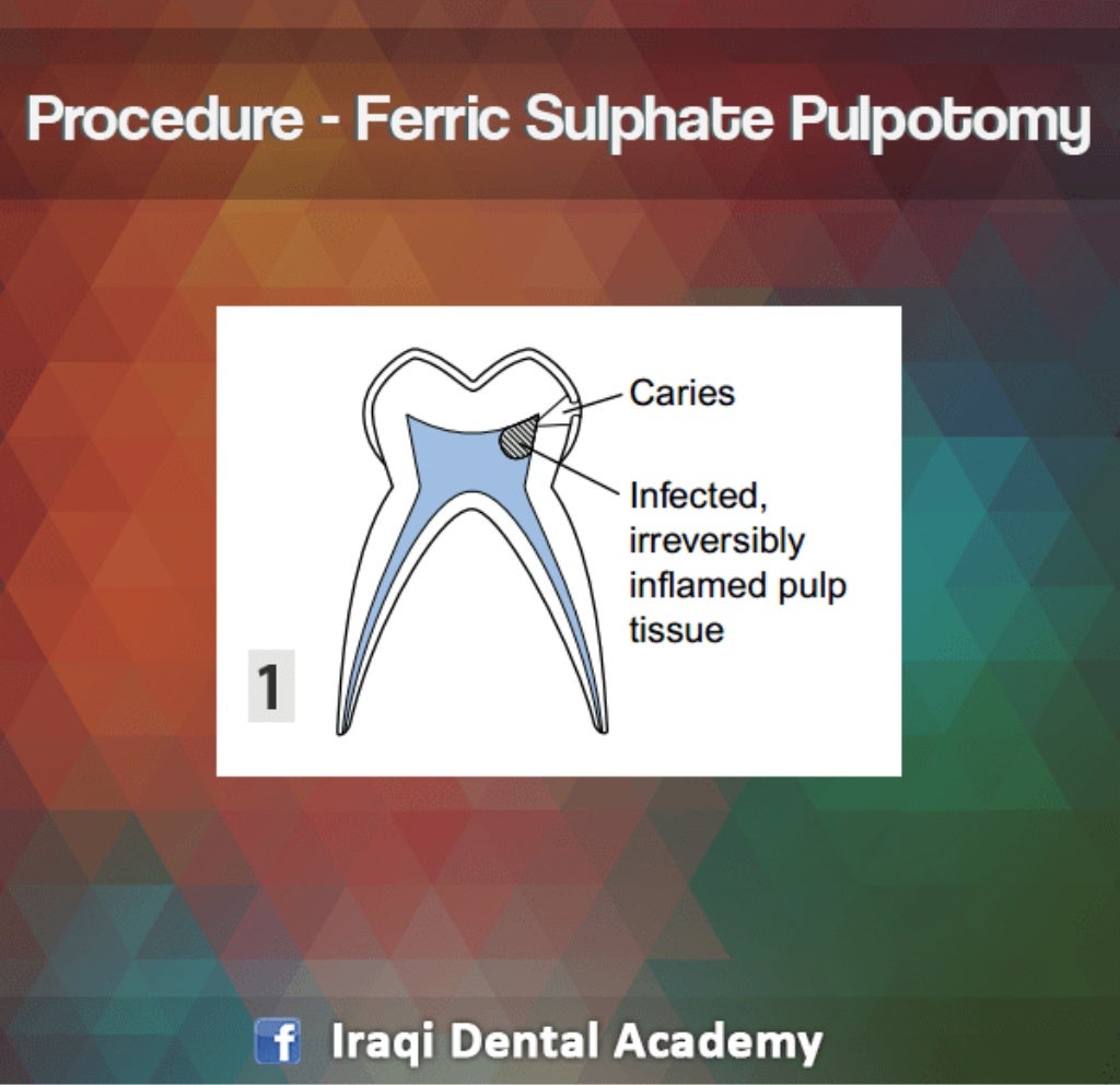 Pulpotomy Procedure for Pediatrics in Detail