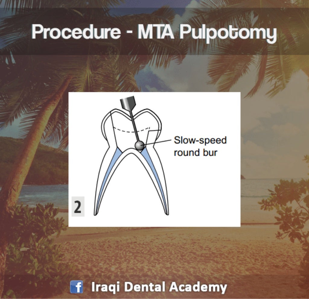 Pulpotomy Procedure for Pediatrics in Detail