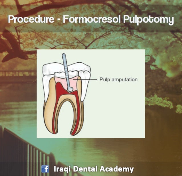 Pulpotomy Procedure for Pediatrics in Detail