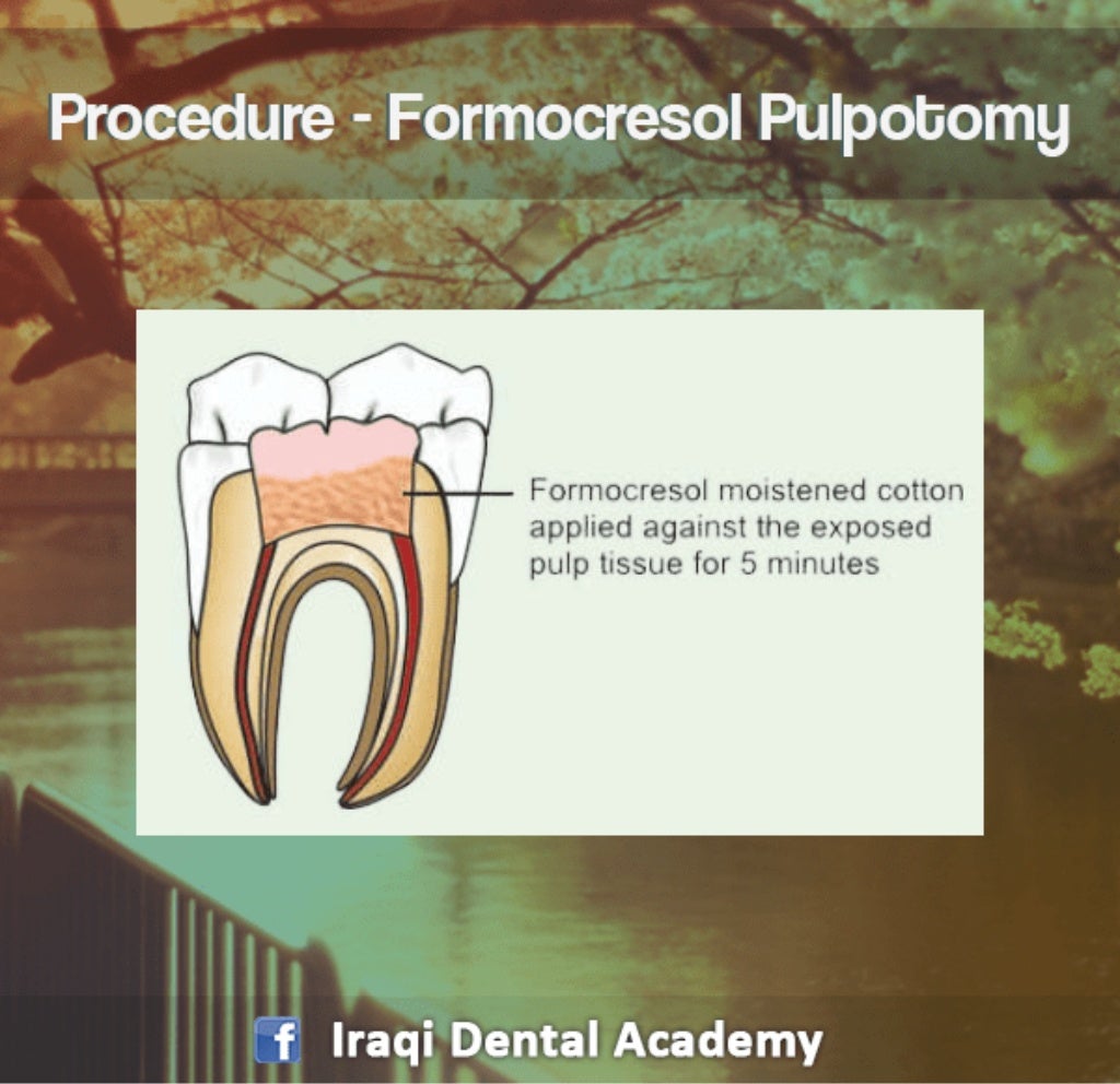 Pulpotomy Procedure for Pediatrics in Detail